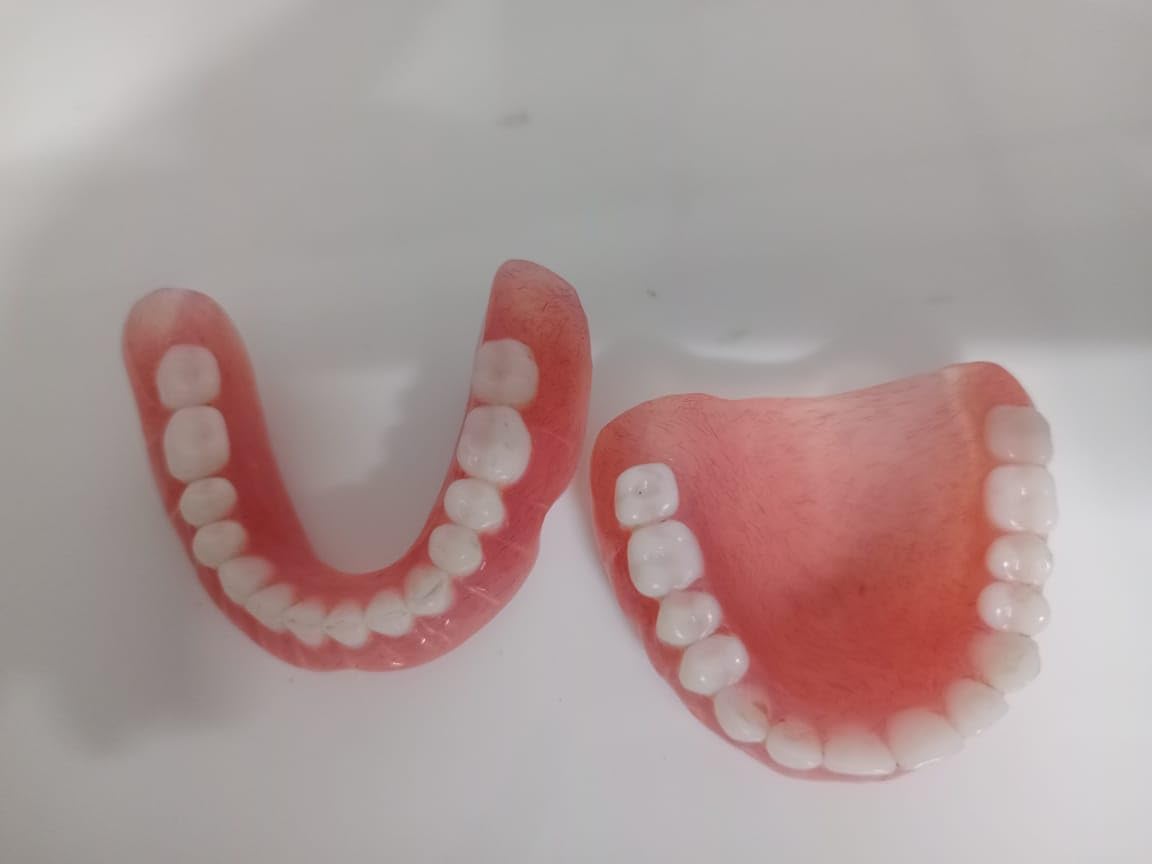Denture full arch upper lower E584